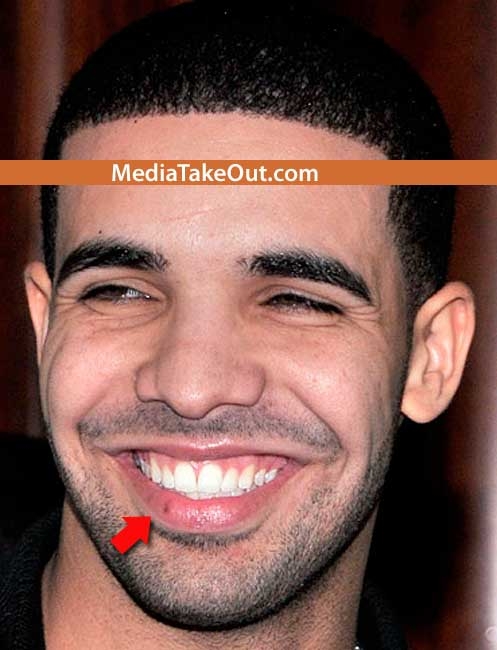 rihanna and drake pictures. Drake sporting herpes sore at