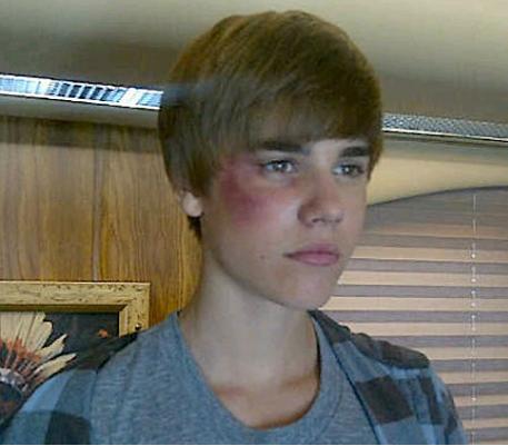 justin bieber eyes 2011. Is Justin Bieber Black Eye