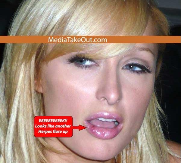 herpes pictures. Paris Hilton Has Herpes